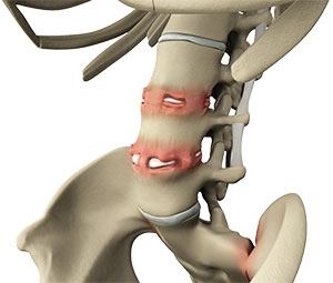  Ankylosing Spondylitis