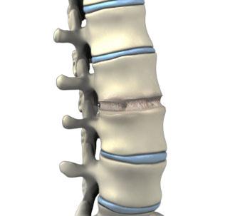  Anterior Lumbar Interbody Fusion