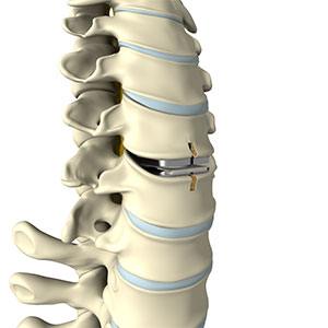  Cervical Arthroplasty 