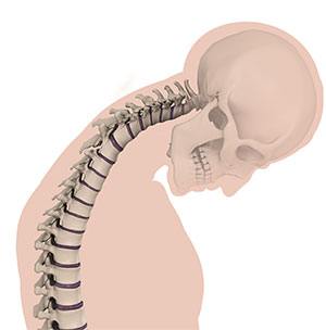 Cervical Deformities