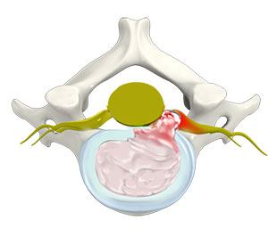  Cervical Disc Herniation