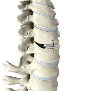  Cervical Disc Replacement 