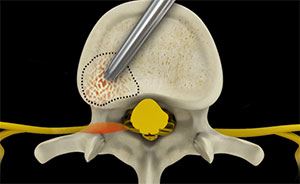  Cervical Foraminotomy