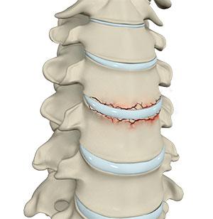 Cervical Fracture