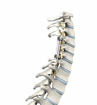   Cervical Laminectomy and Fusion