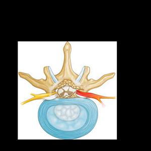  Cervical Radiculopathy/Myelopathy