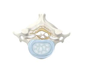 Cervical Stenosis