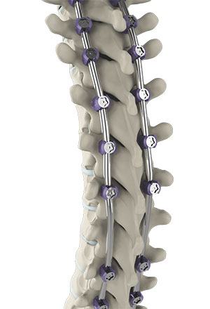  Complex Spinal Surgery 