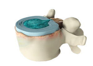 Degenerative Disc Disease