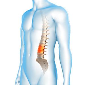 Degenerative Spinal Conditions
