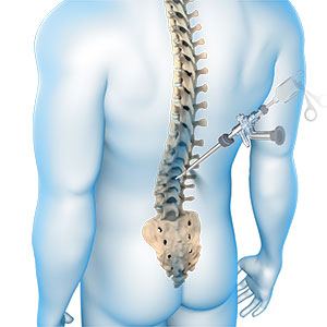 Endoscopic Spine Surgery 