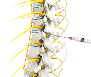 Epidural Steroid Injections 