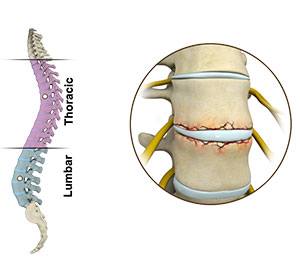 Fractures of the Spine