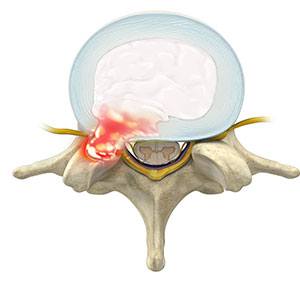  Herniated Disc (Lumbar)