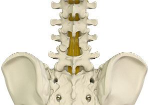 Laminectomy 