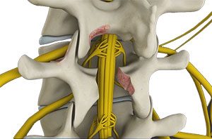  Lumbar Decompression