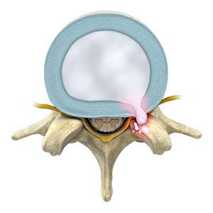 Lumbar Disc Herniation