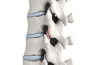 Lumbar Facetectomy and Foraminotomy