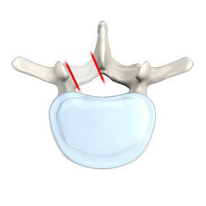 Lumbar  Foraminotomy