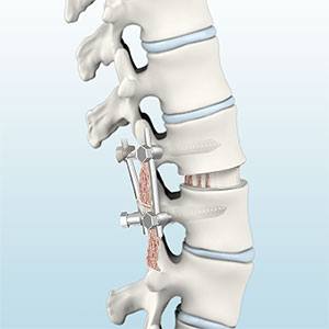 Lumbar  Fusion