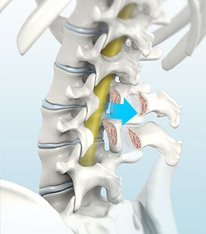  Lumbar Interbody Fusion 