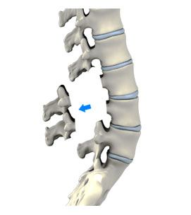  Lumbar Laminectomy 