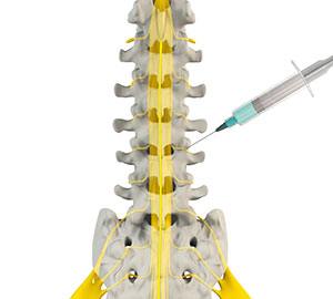 Lumbar Medial Branch Block 