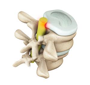 Lumbar Radiculopathy 