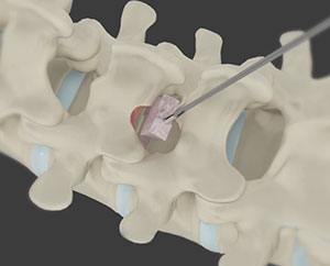 Minimally Invasive Cervical Discectomy  