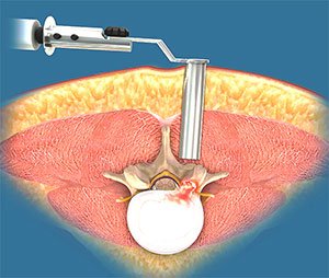 Minimally Invasive Lumbar Surgery