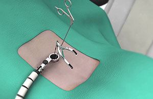 Minimally Invasive Spine Surgery for Spondylolisthesis