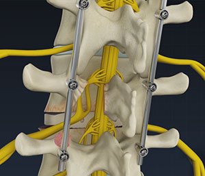 Minimally Invasive TLIF