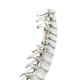 Multilevel Posterior Cervical Laminectomy and Fusion