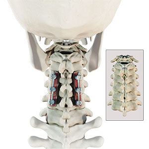 Posterior Cervical Fusion