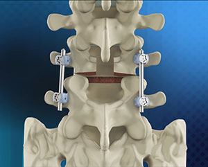 Posterior Lumbar Fusion