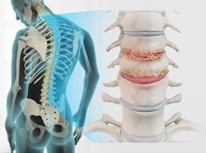 Spinal Stenosis