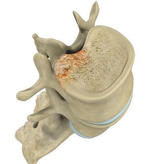 Spinal Tumor Surgery