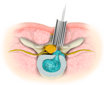 Minimally Invasive Spine Surgery