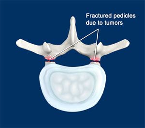 Spondylolisthesis