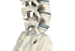 Spondylolysis