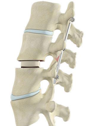 Transforaminal Lumbar Interbody Fusion  