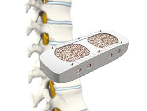 XLIF - Extreme Lateral Interbody Fusion