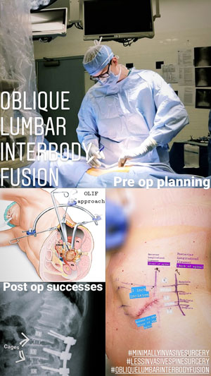 Oblique Lumbar Interbody Fusion (OLIF)