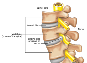 Sciatica