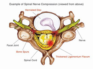 Sciatica