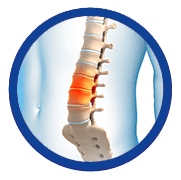 Degenerative Disc Disease