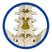 Laminectomy