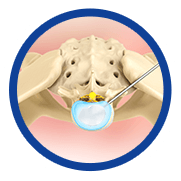 Microdiscectomy