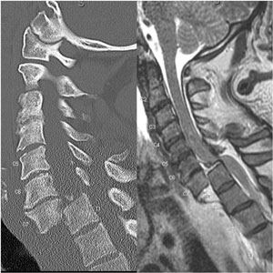 Spine Trauma